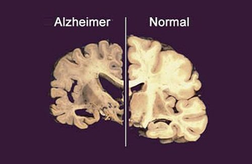 Mujer. Prevenir el Alzheimer