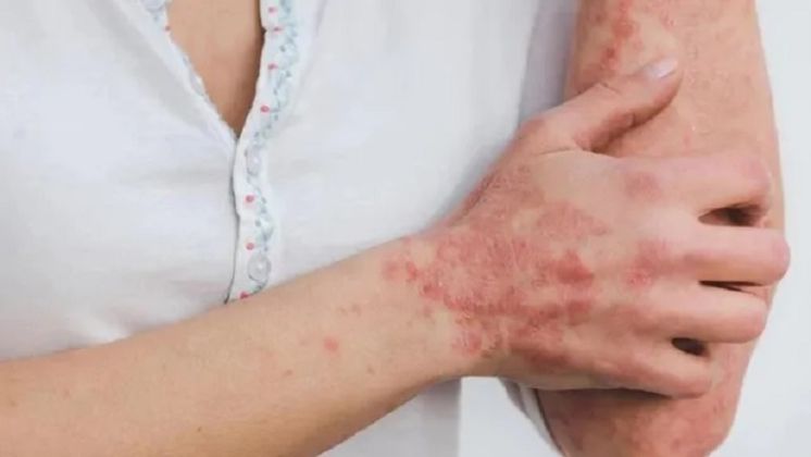 Secretaría de Salud emite aviso epidemiológico de viruela símica